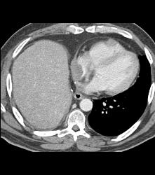 Metastases to the Right Ventricle and Atrium With Renal Mass - CTisus CT Scan