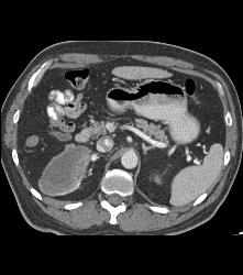 Metastases to the Right Ventricle and Atrium With Renal Mass - CTisus CT Scan