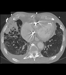 Prior Calcified Infarct of Left Ventricle - CTisus CT Scan