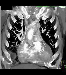 Bypass Grafts Including Left Internal Mammary Artery (LIMA) and Right Internal Mammary Artery (RIMA) - CTisus CT Scan