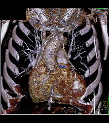 Bypass Grafts Including Left Internal Mammary Artery (LIMA) and Right Internal Mammary Artery (RIMA) - CTisus CT Scan