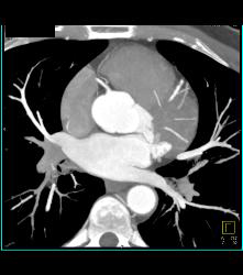 Normal Left Anterior Descending Coronary Artery (LAD) - CTisus CT Scan