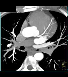 Normal Left Anterior Descending Coronary Artery (LAD) - CTisus CT Scan