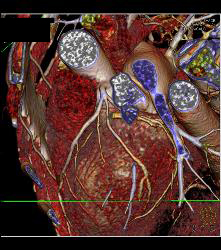 Normal Left Anterior Descending Coronary Artery (LAD) - CTisus CT Scan