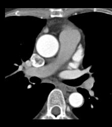 Perfect Timing for CTA or Aortic Dissection - CTisus CT Scan