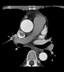 Perfect Timing for CTA or Aortic Dissection - CTisus CT Scan