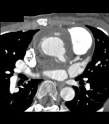 Dilated Left Main Coronary Artery Origin Following Reimplantation of the Vessel - CTisus CT Scan