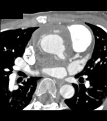 Dilated Left Main Coronary Artery Origin Following Reimplantation of the Vessel - CTisus CT Scan