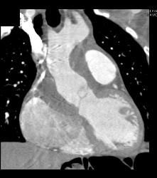 Repair of Aortic Root and Ascending Aorta - CTisus CT Scan