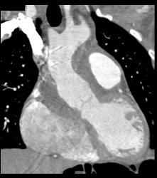 Repair of Aortic Root and Ascending Aorta - CTisus CT Scan