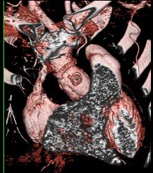 Repair of Aortic Root and Ascending Aorta - CTisus CT Scan