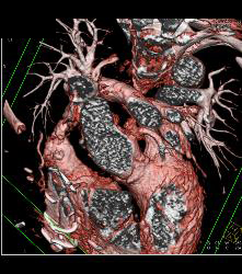 Repair of Aortic Root and Ascending Aorta - CTisus CT Scan