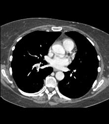 Incidental Pulmonary Embolism (PE) and Left Deep Vein Thrombosis (DVT) - CTisus CT Scan