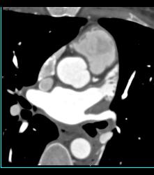 Normal Left Atrial Appendage - CTisus CT Scan