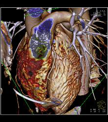 Normal Left Atrial Appendage - CTisus CT Scan