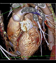 Normal Left Atrial Appendage - CTisus CT Scan