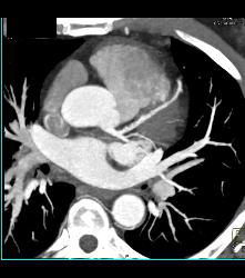 Left Anterior Descending Coronary Artery (LAD) Plaque - CTisus CT Scan