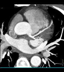 Left Anterior Descending Coronary Artery (LAD) Plaque - CTisus CT Scan