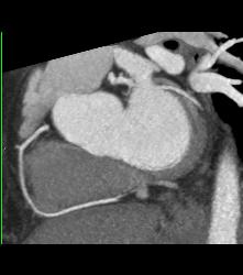 Left Anterior Descending Coronary Artery (LAD) Plaque - CTisus CT Scan