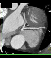 Left Anterior Descending Coronary Artery (LAD) Plaque - CTisus CT Scan