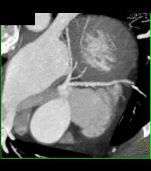 Left Anterior Descending Coronary Artery (LAD) Plaque - CTisus CT Scan