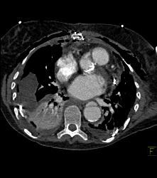 Reimplantation of Left Coronary Artery Off Right Cusp - CTisus CT Scan