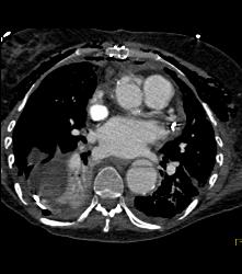 Reimplantation of Left Coronary Artery Off Right Cusp - CTisus CT Scan