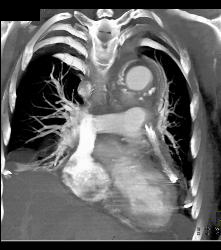 Reimplantation of Left Coronary Artery Off Right Cusp - CTisus CT Scan