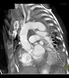 Reimplantation of Left Coronary Artery Off Right Cusp - CTisus CT Scan