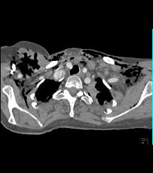 Post-op Aortic Aneurysm Repair - CTisus CT Scan