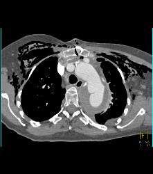 Post-op Aortic Aneurysm Repair - CTisus CT Scan