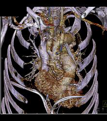 Repair of Root, Ascending Aorta, and Reimplantation of Arch Vessels - CTisus CT Scan