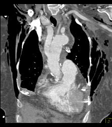 Repair of Root, Ascending Aorta, and Reimplantation of Arch Vessels - CTisus CT Scan