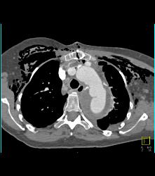 Repair of Root, Ascending Aorta, and Reimplantation of Arch Vessels - CTisus CT Scan