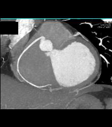 Normal RCA - CTisus CT Scan