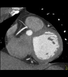 Normal RCA - CTisus CT Scan