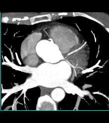 Normal RCA - CTisus CT Scan