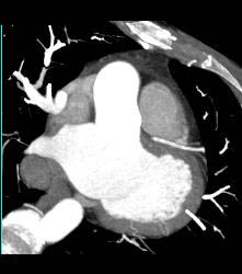 Normal RCA - CTisus CT Scan