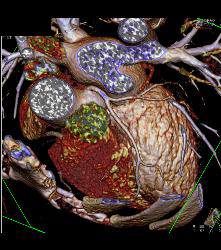 Normal RCA - CTisus CT Scan