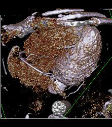 Normal RCA - CTisus CT Scan