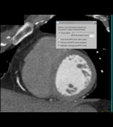 This Sequence Shows How Changing Slab Thickness Impacts on the Amount of RCA Displayed - CTisus CT Scan