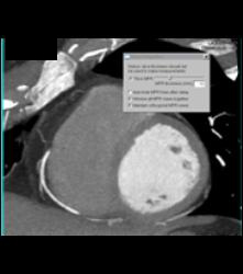 This Sequence Shows How Changing Slab Thickness Impacts on the Amount of RCA Displayed - CTisus CT Scan