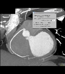 This Sequence Shows How Changing Slab Thickness Impacts on the Amount of RCA Displayed - CTisus CT Scan