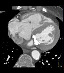 Normal Circumflex - CTisus CT Scan