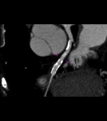 RCA Disease - CTisus CT Scan