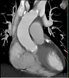 Left Anterior Descending Coronary Artery (LAD) Disease - CTisus CT Scan