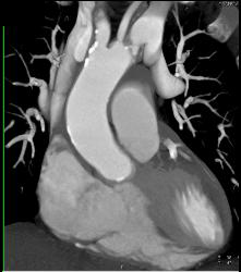 Left Anterior Descending Coronary Artery (LAD) Disease - CTisus CT Scan