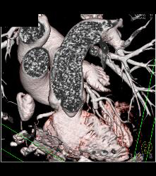 Left Anterior Descending Coronary Artery (LAD) Disease - CTisus CT Scan