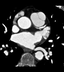 Left Anterior Descending Coronary Artery (LAD) Disease - CTisus CT Scan