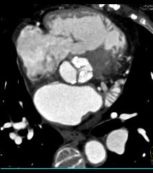 Diseased Aortic Valve - CTisus CT Scan